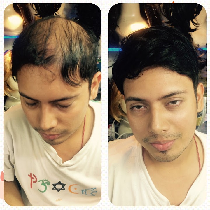 Hair World – Best Hair Replacement Center in Kolkata